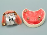コーヌス・奥歯のアタッチメント入れ歯・麻布十番の歯科医院